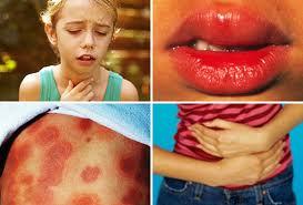 Αλλεργικό Shock: Τι είναι και τι το προκαλεί;